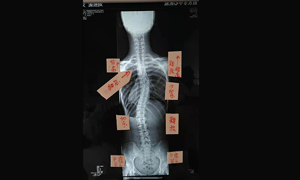 什么是脊柱畸形和脊柱側彎