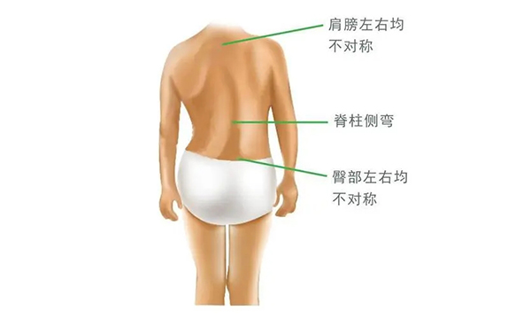 什么是脊柱側(cè)彎？
